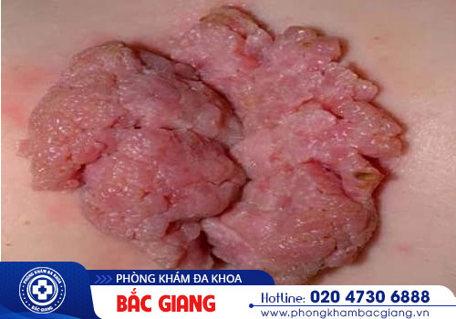 Điểm danh các biển hiện ban đầu sùi mào gà ở nam giới