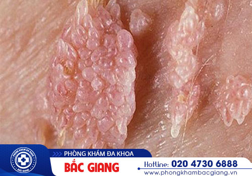 Điểm danh các biển hiện ban đầu sùi mào gà ở nữ giới