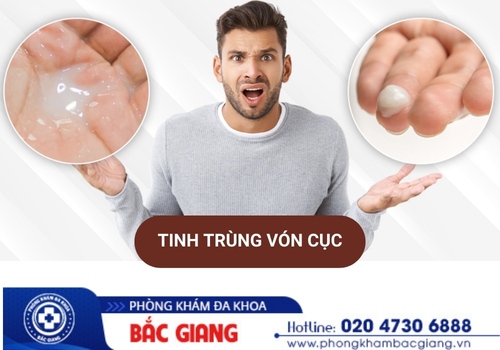 điều trị tinh trùng vón cục tại bắc giang