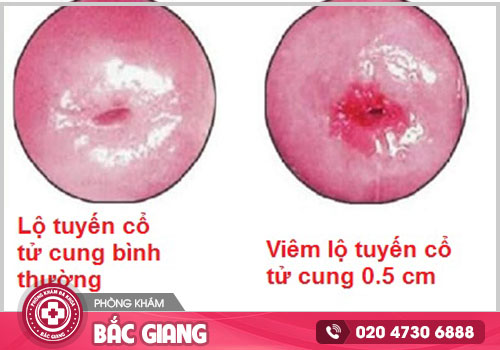 Điều trị viêm lộ tuyến cổ tử cung tại Bắc Giang địa chỉ nào chất lượng, an toàn?