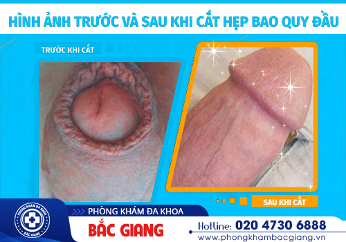 Tình dài bao quy đầu được khắc phục sau tiểu phẫu