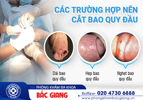 Độ tuổi nào nên cắt bao quy đầu - Tư vấn bác sĩ