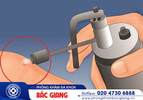 Đốt điện sùi mào gà là gì? Có hiệu quả không?