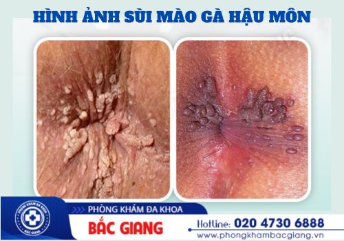 hậu môn nổi mụn thịt có phải bị sùi mào gà