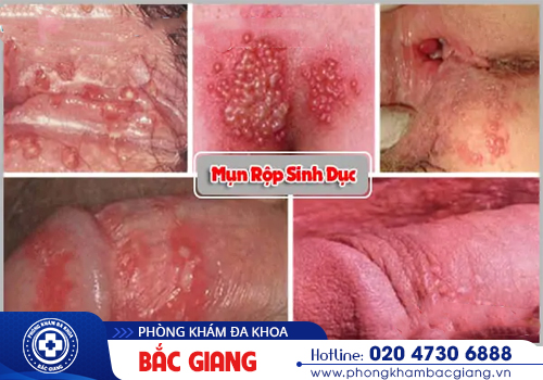 Dương vật nổi mụn rộp - Cảnh báo nhiễm bệnh xã hội