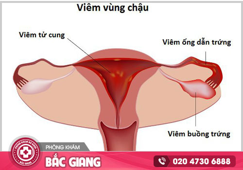Giá chữa bệnh viêm vùng chậu ở Bắc Giang là bao nhiêu? Có mắc không?