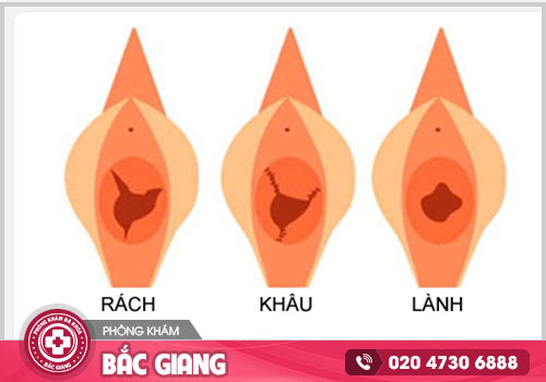 Giá vá màng trinh tại Bắc Giang là bao nhiêu tiền hiện nay?