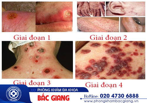 Giang mai - Căn bệnh tình dục nguy hiểm đe doạ trực tiếp đến sự sống người bệnh