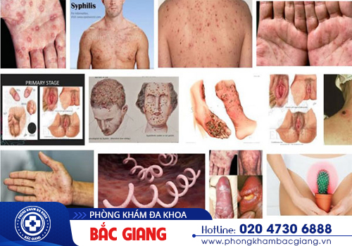 điều trị giang mai có đắt không