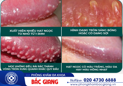 Hạt ngọc dương vật là gì? Có nguy hiểm không?