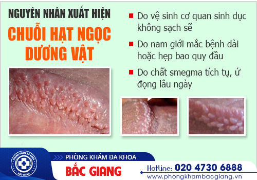 Hạt ngọc dương vật là gì? Có nguy hiểm không?
