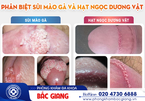 Hạt ngọc dương vật là gì? Có nguy hiểm không?