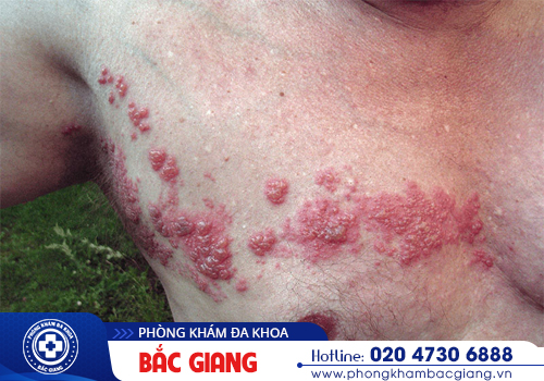 Herpes là bệnh gì? Chớ chủ quan với loại virus lây nhiễm này