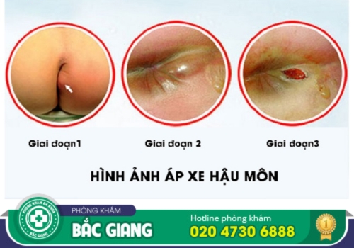 chi phí chữa ap xe hậu môn tại bắc giang