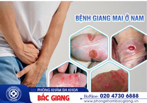 hình ảnh giang mai ở nam và nữ