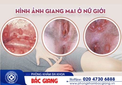 hình ảnh giang mai ở nam và nữ