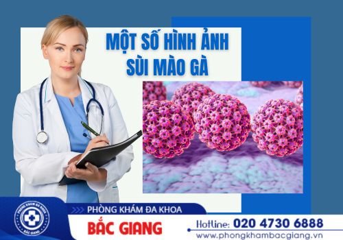 hình ảnh sùi mào gà
