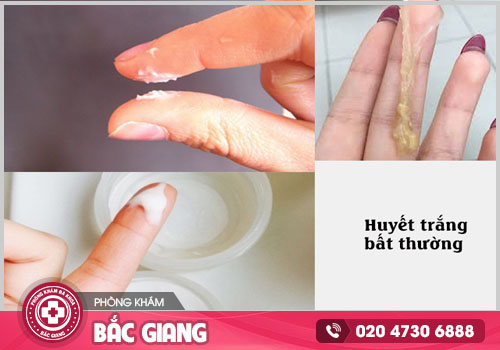 Tìm hiểu về bệnh huyết trắng và cách xử lý