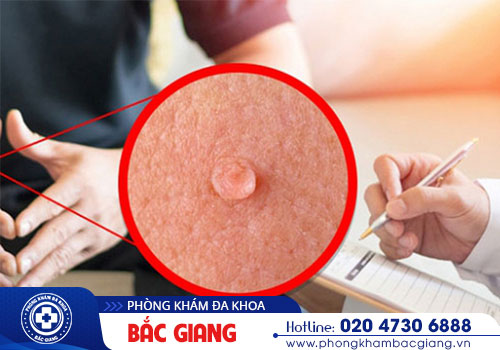 Khám sùi mào gà ở đâu uy tín, chất lượng?