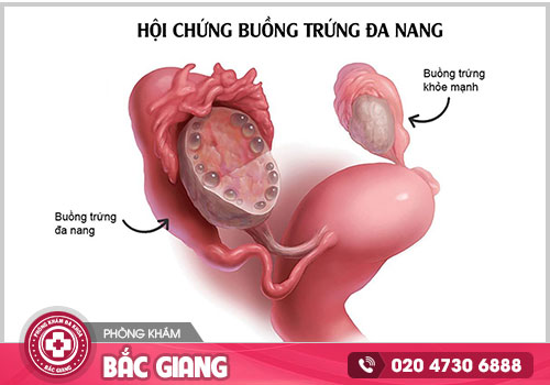 Khám và chữa buồng trứng đa nang ở Bắc Giang địa chỉ nào đáng tin cậy?