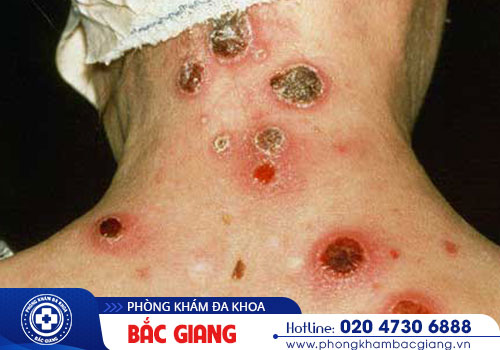 Khi nào thì cần thiết xét nghiệm bệnh giang mai?