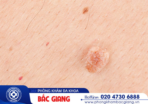 lam-the-nao-de-nhan-biet-sui-mao-ga-giai-doan-dau-61