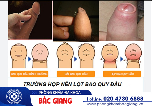 Có nên tự lột bao quy đầu tại nhà?