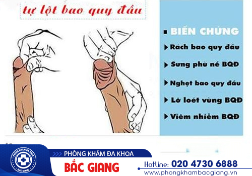 Có nên tự lột bao quy đầu tại nhà?