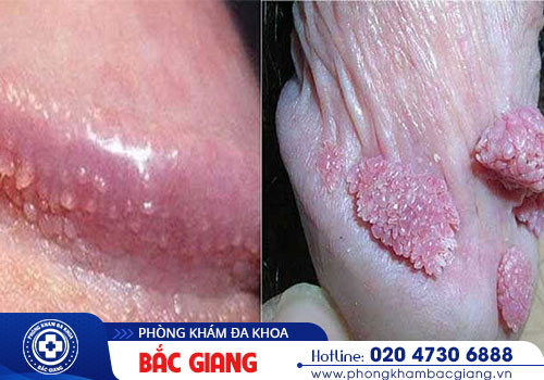 Mua thuốc bôi trị hạt ngọc dương vật liệu có tốt không?