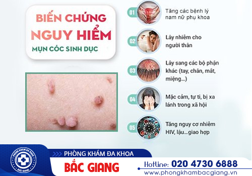 Mụn cóc sinh dục Căn bệnh nhiều người dễ mắc phải nhưng ngại thăm khám