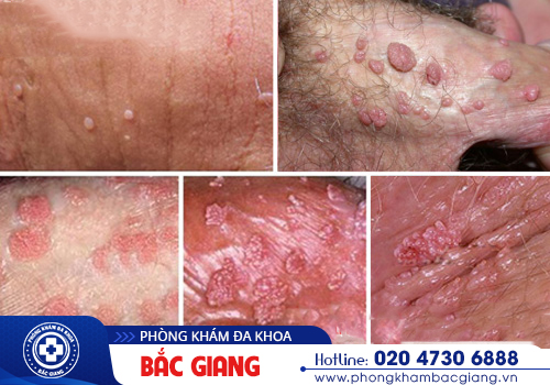 Mụn cóc sinh dục Căn bệnh nhiều người dễ mắc phải nhưng ngại thăm khám