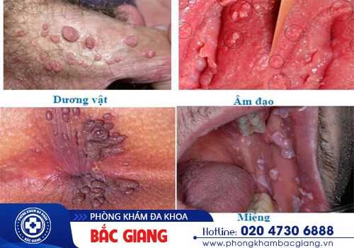 Mụn cóc sinh dục Căn bệnh nhiều người dễ mắc phải nhưng ngại thăm khám