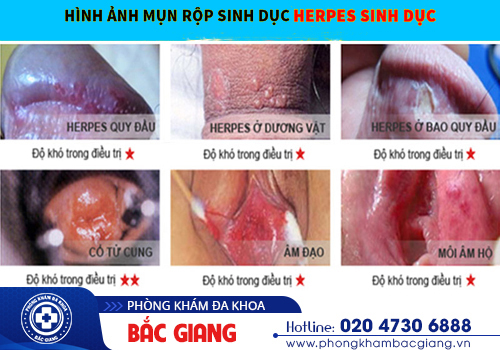 Mục rộp sinh dục: Chớ coi thường!