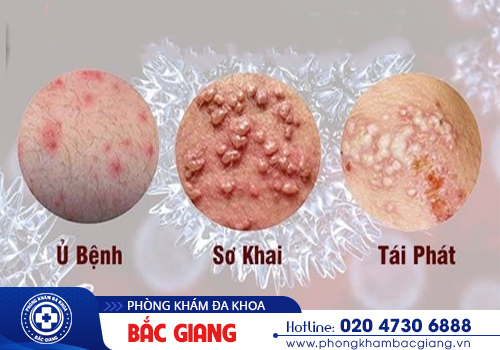 Mục rộp sinh dục: Chớ coi thường!