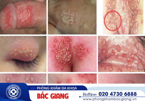 Mục rộp sinh dục: Chớ coi thường!