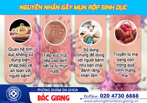 Mục rộp sinh dục: Chớ coi thường!