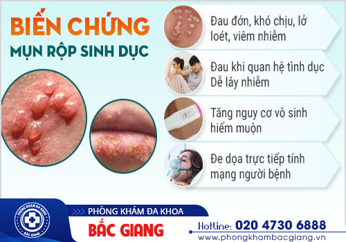 Mục rộp sinh dục: Chớ coi thường!