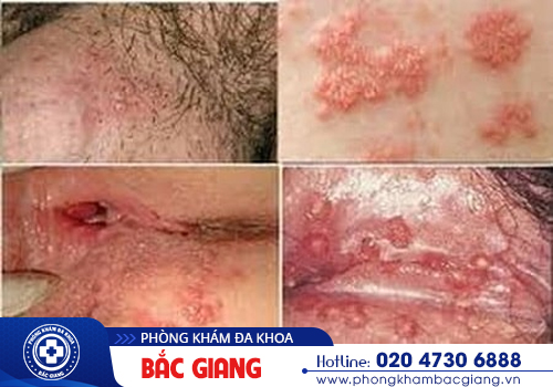 Mụn rộp vùng kín là bệnh gì? Dấu hiệu của mụn rộp sinh dục