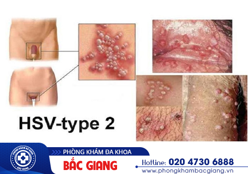 Mụn rộp vùng kín là bệnh gì? Dấu hiệu của mụn rộp sinh dục