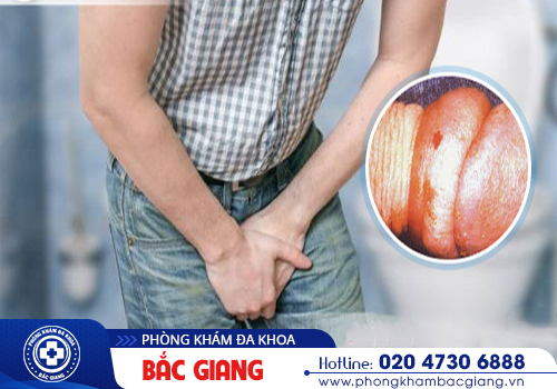 Nghẹt bao quy đầu là gì? Có nguy hiểm với sức khoẻ không?