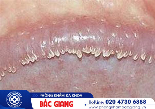 Nguyên nhân và hình ảnh nhận biết hạt ngọc dương vật