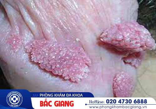 Nhận biết các dấu hiệu sùi mào gà thường gặp