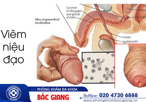 Nhận biết hình ảnh viêm nhiễm nam khoa thường gặp