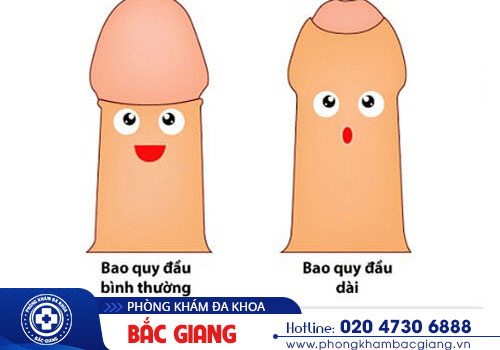 Nhận biết những biểu hiện dài bao quy đầu