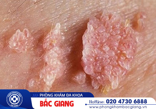 Nhận biết những triệu chứng nhiễm HPV