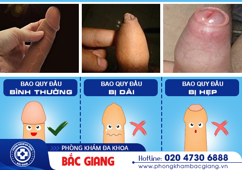 Ảnh hưởng không nhỏ của hẹp bao quy đầu?