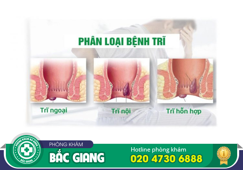 Nội soi trĩ thực hiện như thế nào? Cần lưu tâm gì?
