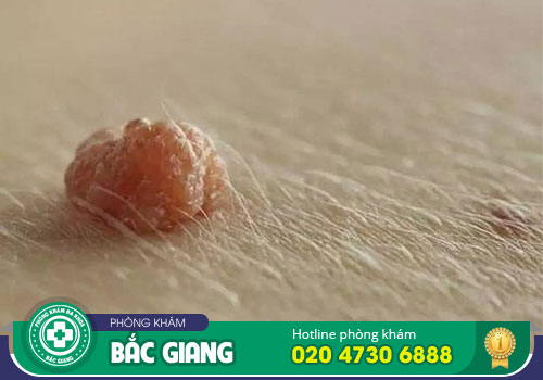 Nổi thịt thừa ở mông nguyên nhân do đâu? Điều trị như thế nào?