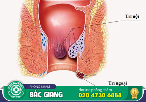 Nổi thịt thừa ở mông nguyên nhân do đâu? Điều trị như thế nào?