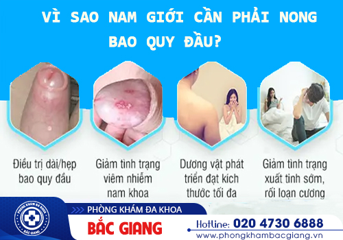 Khi nào nam giới cần nong bao quy đầu? Cách thực hiện an toàn